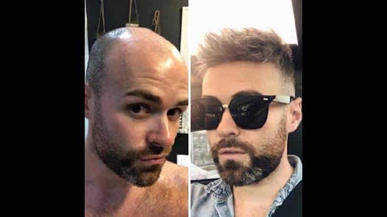 FOLIXIL Funciona? FOLIXIL Vale a Pena?